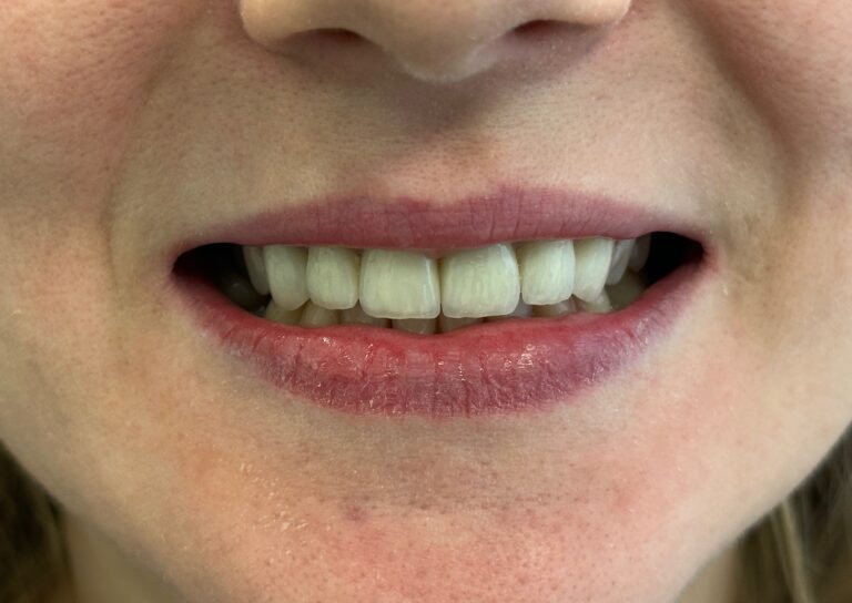 Licówki porcelanowe górnego łuku - po