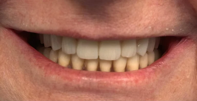 Przed: Stare protezy<br>Po: Odbudowy ALL-ON-4 na implantach - przed
