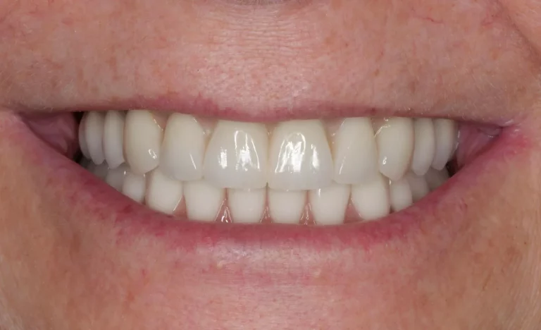 Przed: Stare protezy<br>Po: Odbudowy ALL-ON-4 na implantach - po