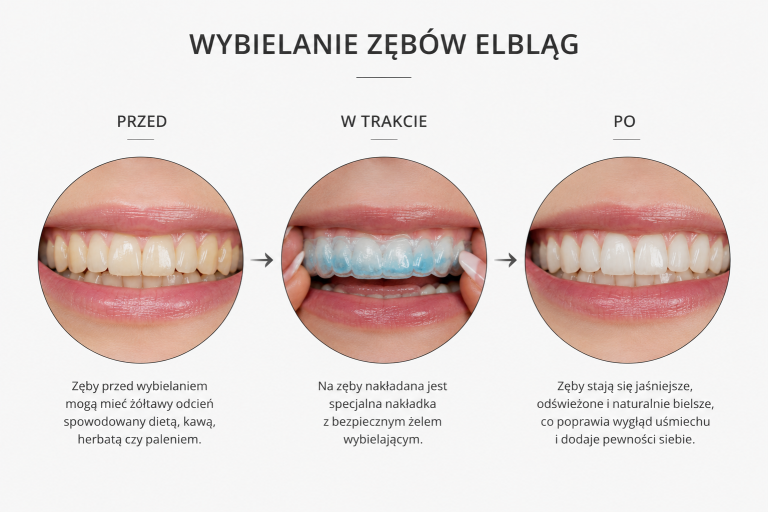 Wybielanie zębów Elbląg